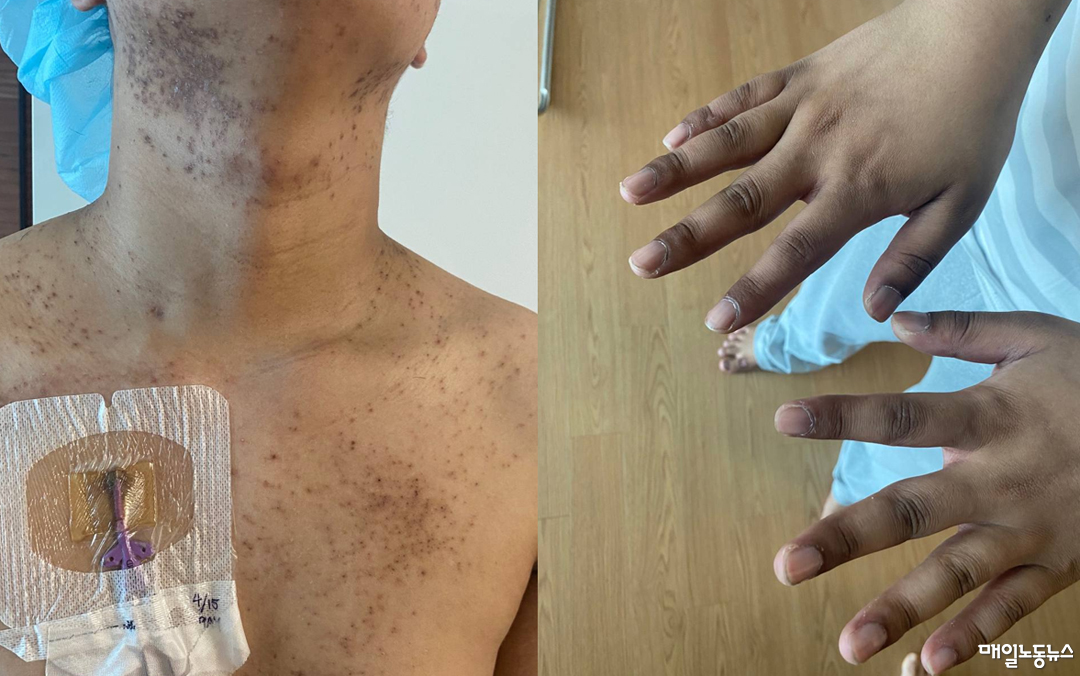 삼성전자 1차 하청업체에서 일하던 수현(21·가명)씨가 급성 골수형 백혈병에 걸려 치료를 받은 뒤 몸에는 열꽃이 피어있다. <반올림 제공>