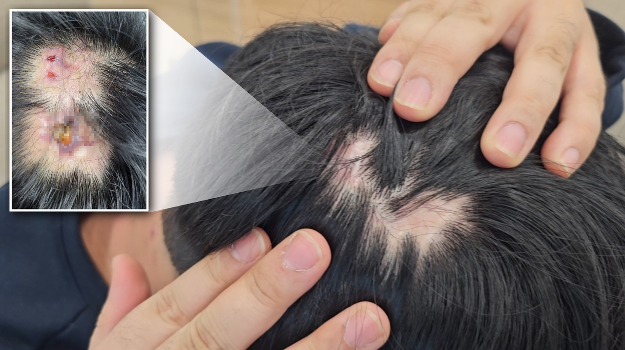 경북의 한 도립대 겸임교수 이아무개씨의 제자이자 스타트업 직원인 김동수씨는 2022년 1월께부터 이 교수로부터 지속해 폭행당했다. 이 교수가 휴대전화로 머리를 찍어 김씨의 머리에 상처가 난 모습. 폭행 이후 더 이상 머리가 자라지 않는다. <홍준표 기자>